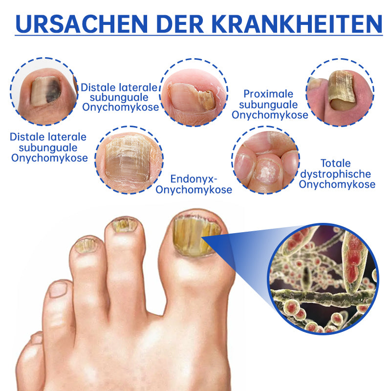 đFurzero⢠PureNail Pilz-Lasertherapiegerät