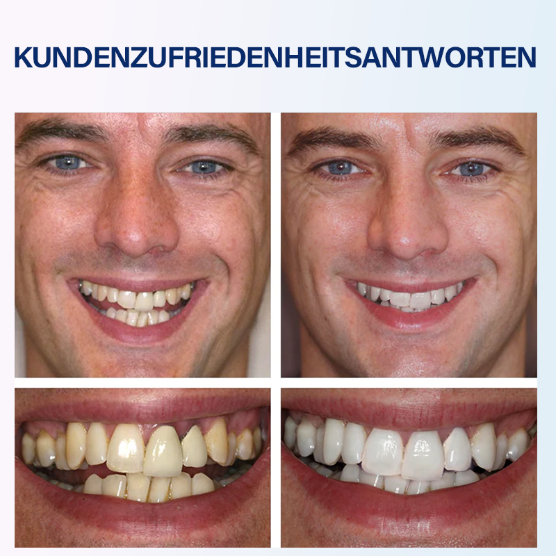 Furzero™ Medizinischer Serumstift zur Zahnaufhellung