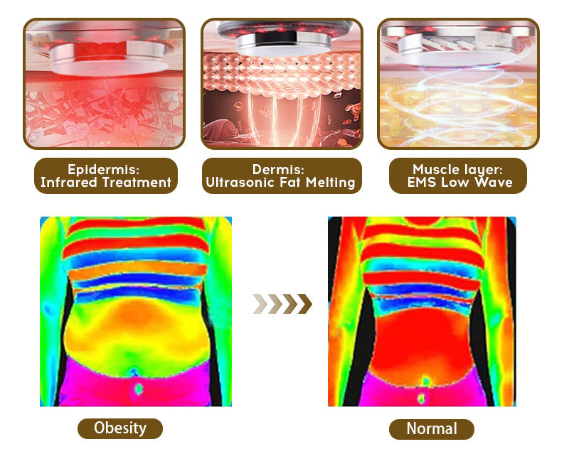 👨⚕️Furzero™ EMS-Ultraschall-Ferninfrarot-Anti-Cellulite-Massagegerät(👨⚕️Arztempfehlung)