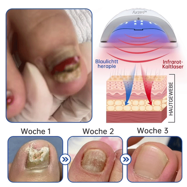 đFurzero⢠PureNail Pilz-Lasertherapiegerät