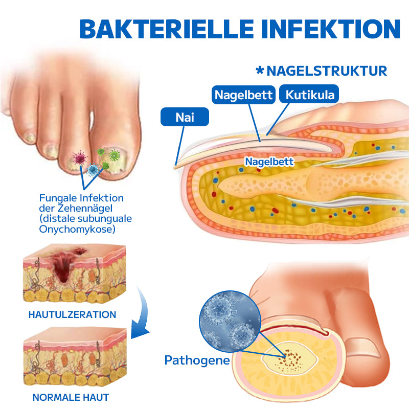 đ„ Furzeroâą Nagelpilz-FuĂspray