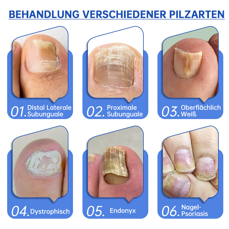 đFurzero⢠PureNail Pilz-Lasertherapiegerät