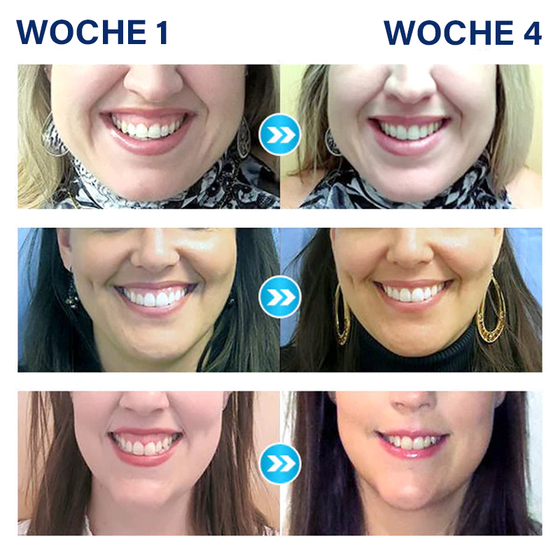 Furzero™ Medizinischer Serumstift zur Zahnaufhellung