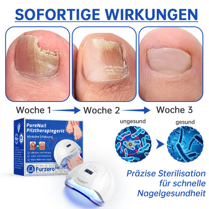 👏Furzero™ PureNail Pilz-Lasertherapiegerät