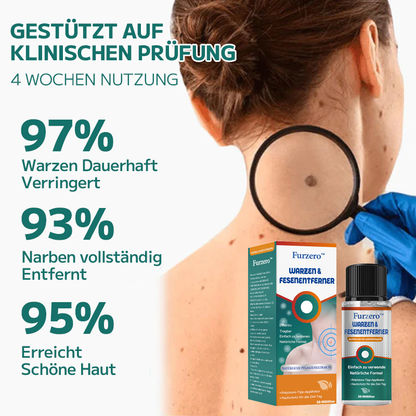 Furzero™ Warzen- und Muttermalentferner (Ermäßigung für begrenzte Zeit 🔥 letzter Tag)