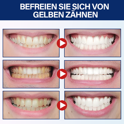 Furzero™ Medizinischer Serumstift zur Zahnaufhellung