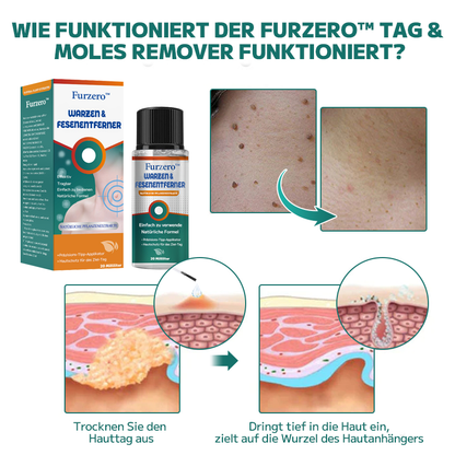 Furzero™ Warzen- und Muttermalentferner (Ermäßigung für begrenzte Zeit 🔥 letzter Tag)