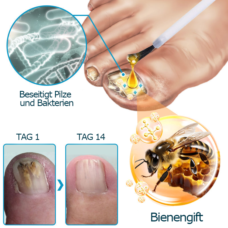 Furzero™ Bienengift Nagelpilz-Behandlungslösung💅
