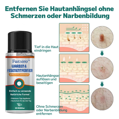 Furzero™ Warzen- und Muttermalentferner (Ermäßigung für begrenzte Zeit 🔥 letzter Tag)