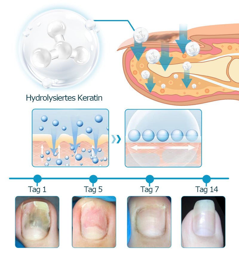 Furzero™ Bienengift Nagelpilz-Behandlungslösung💅