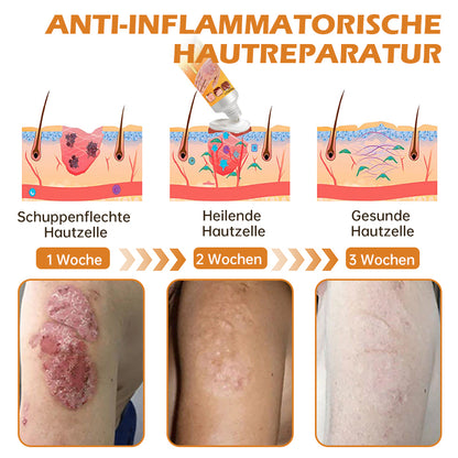 🐝Furzero™ Neuseeland Bienengift Psoriasis-Behandlungscreme (Geeignet für alle Hautbedingungen)