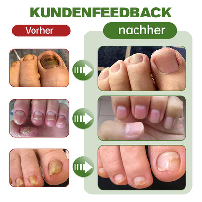 Furzero™ Medi-Care Anti-Pilz-Stick