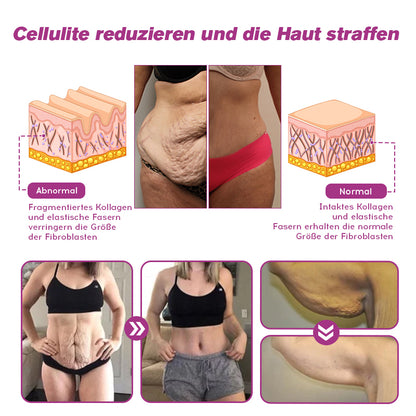 🐝Furzero™ BeeVenom Fettverbrennungscreme（Geeignet für schlaffe Haut nach Gewichtsverlust und postpartale Erschlaffung ）