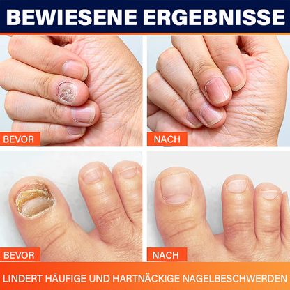 Furzero™ 5 Tage Zehennagelpilz Schnellreparaturstift