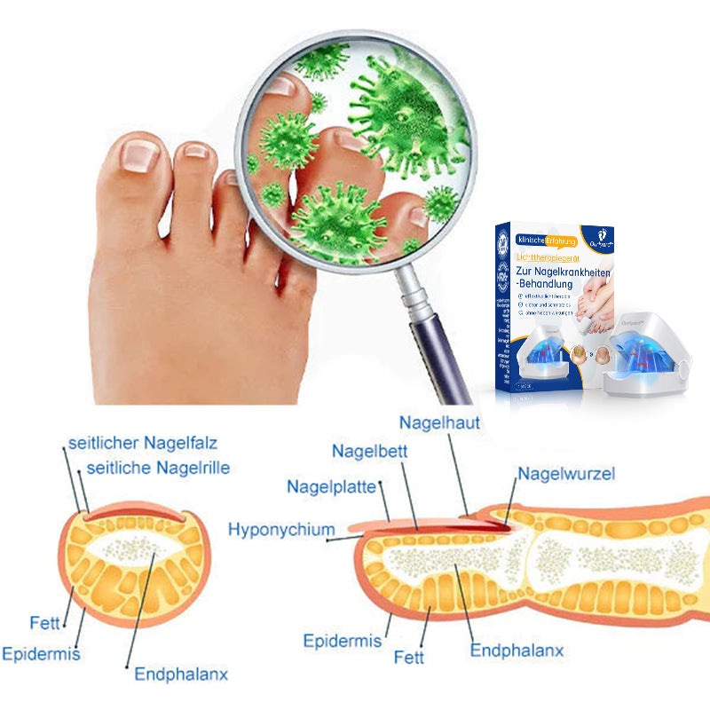 Ourlyard™ Leistungsfähiges Lichttherapiegerät zur Behandlung von Nagelerkrankungen