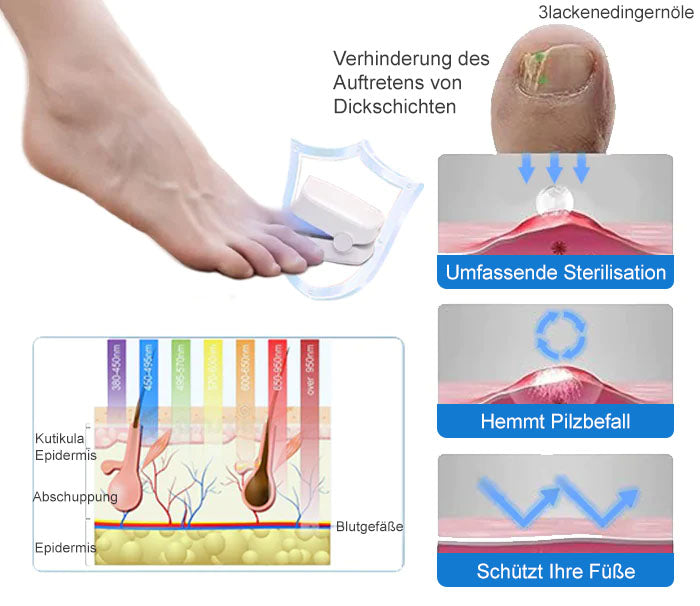 Ourlyard™ Leistungsfähiges Lichttherapiegerät zur Behandlung von Nagelerkrankungen