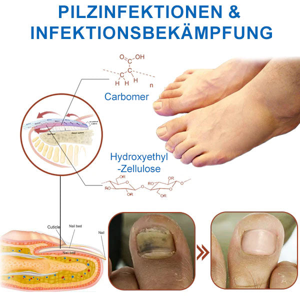 Ourlyard™ Leistungsfähiges Lichttherapiegerät zur Behandlung von Nagelerkrankungen